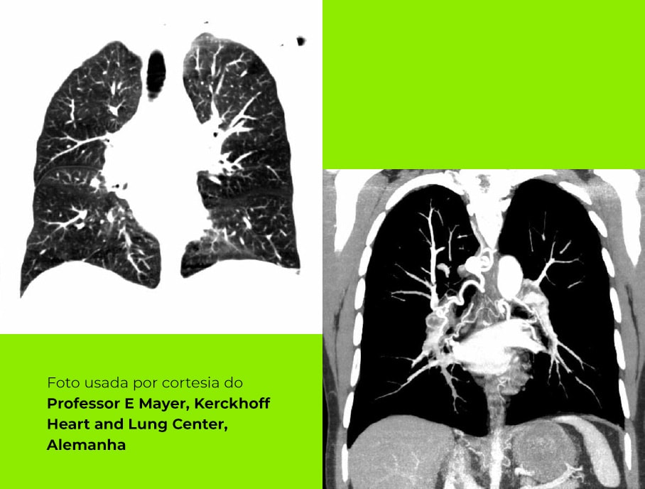 Angiografia pulmonar por tomografia computadorizada Alt tag